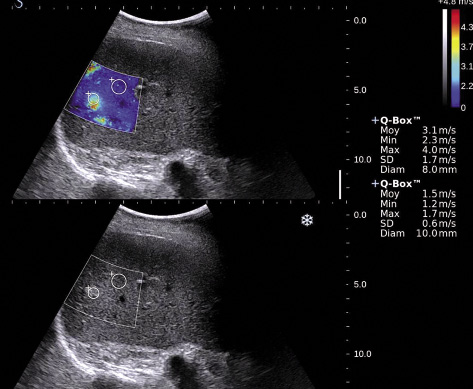 New ultrasound elastometry techniques: technique and indications in clinical practice - FMC-HGE