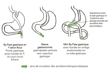 Figure 1. Circulation des secrétions bilio-pancréatiques après 3 montages de chirurgies bariatriques