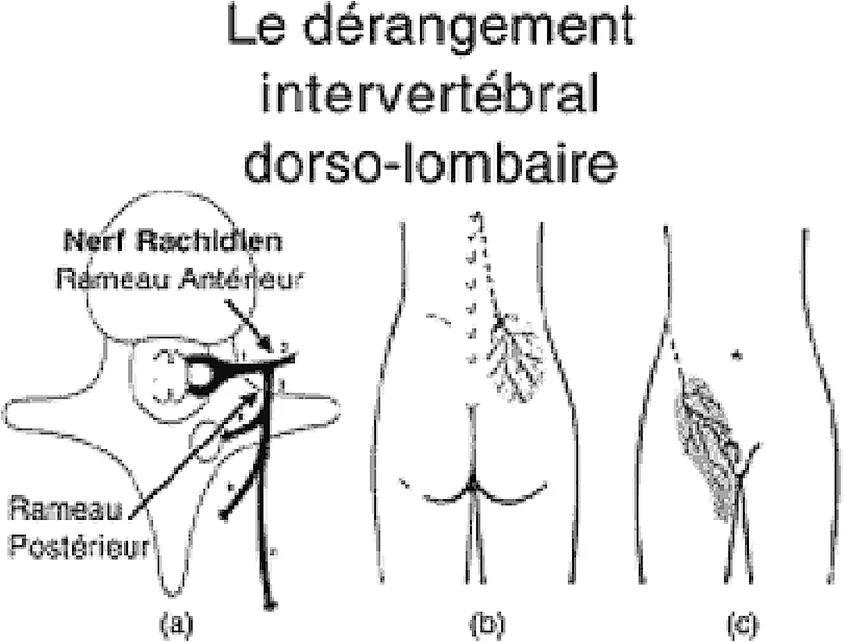 Figure 3. Le dérangement inter-vertébral dorso-lombaire.