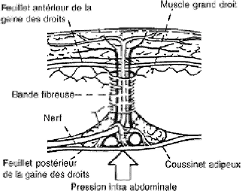 Figure 4. Mécanisme d’une douleur pariétale par conflit du rameau antérieur d’un nerf cutané abdominal au niveau de sa gaine fibreuse au bord du muscle grand droit de l’abdomen [2]
