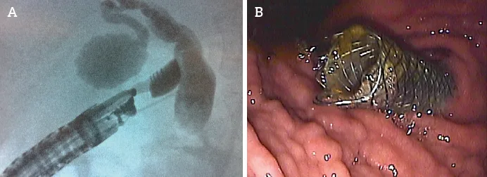 Figure 1 : Choledocoduodenostomie
