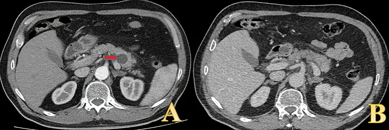 Figure 4 A-B : Radio Fréquence : ablation d’une TNE de la queue du pancréas