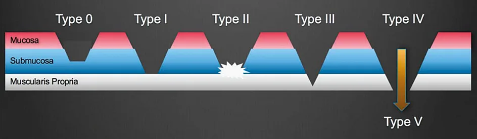 Figure 2. Schéma de la classification de Sydney de Burgess et al.