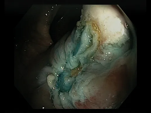 Photo 1. Perforation transmurale sur zone de résection avec « target sign »