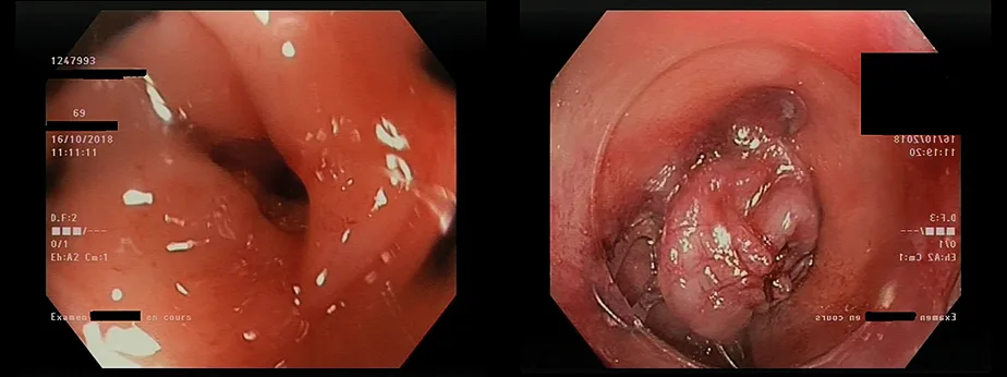 Photo 3. Fermeture par OVESCO d’une perforation de la charnière rectosigmoïdienne