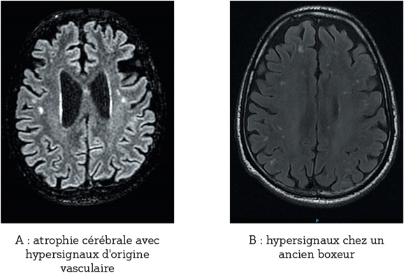 exemples d’IRM permettant de redresser le diagnostic d’EH minime : A : atrophie cérébrale avec hypersignaux en faveur d’une démence vasculaire ; B : hypersignaux chez un ancien boxeur