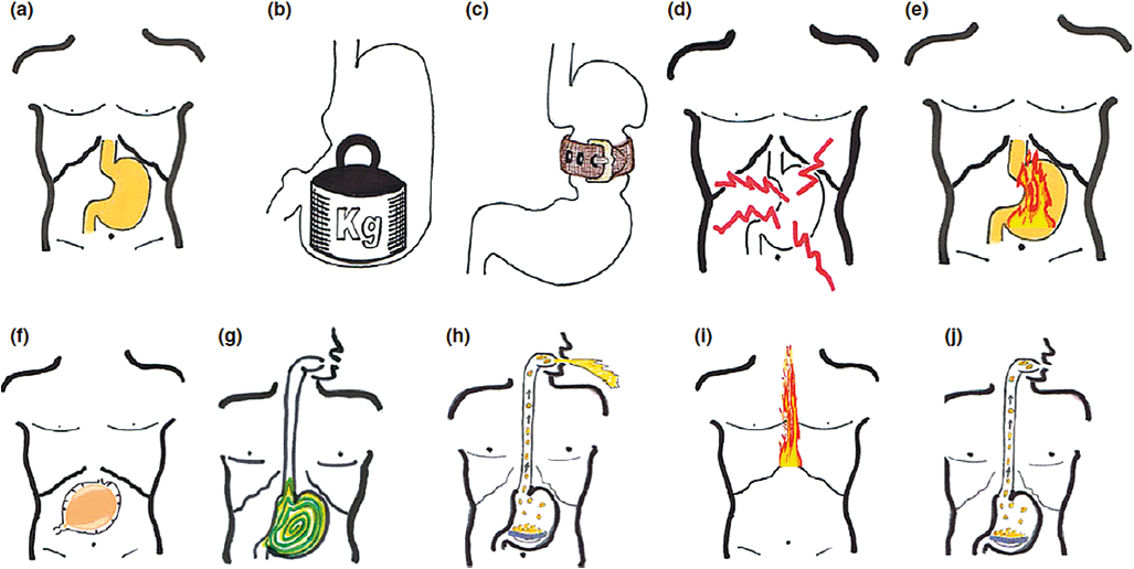 Figure 1 : Pictogrammes indiquant a) la localisation de l’estomac, b) la pesanteur post-prandiale, c) la satiété précoce, d) la douleur, e) la brûlure épigastrique, f) le ballonnement épigastrique, g) la nausée, h) le vomissement, i) la brûlure d’estomac et j) la régurgitation (9)