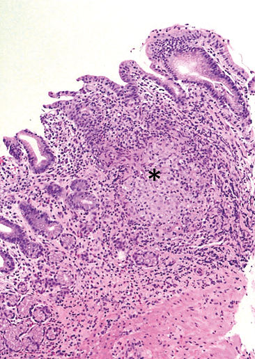 Figure 5 : Gastrite antrale granulomateuse chez un patient atteint d’une maladie de Crohn :