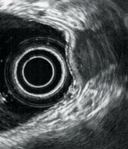 Figure 3 : Infiltration de la musculeuse rectale