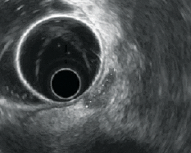 Figure 4 : adhérence à la face antérieure du rectum