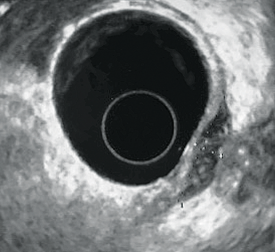 Figure 6 : Infiltration de la paroi rectale par un nodule duligament utéro-sacré