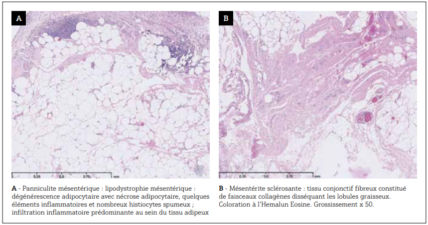 Aspcets anatomopathologiques dela panniculite mésentérique