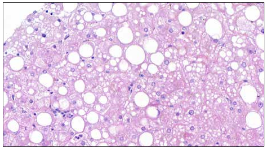 Stéatose avec steatohepatique (HES x 300)