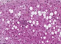 A - Hépatite alcoolique avec hépatocytes en nécrose ou apoptose entourés de polynucléaires neutrophiles, faible grossissement x 10