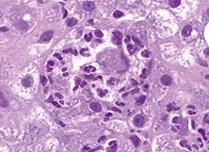 C - Courtoisie Pr. Denis Chatelain, Service Anatomopathologie CHU Amiens- Picardie.