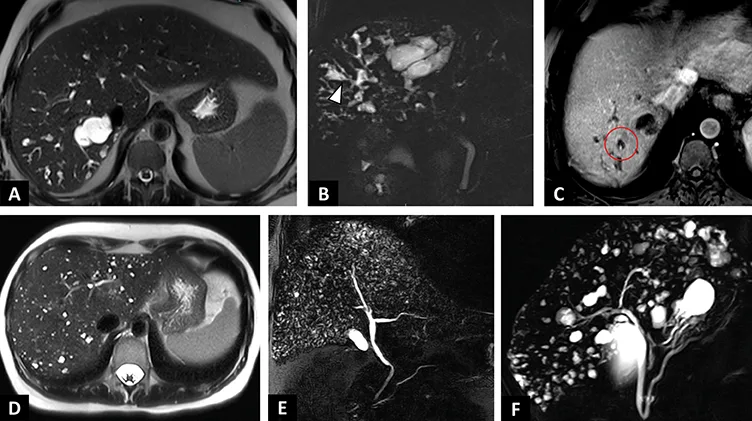 Figure 3 : Anomalies de la plaque ductale