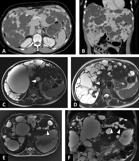 Figure 4 : Exemples de polykystoses hépatiques