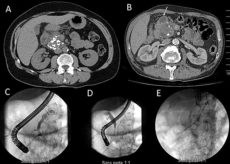 Pancr atite Chronique Et Cancer D pistage Et Diagnostic Pr coce FMC HGE Pancr atite Chronique Et Cancer D pistage Et Diagnostic Pr coce FMC HGE