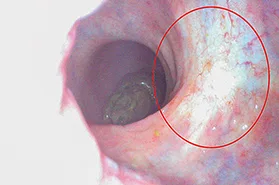 Figure 1A : Réponse endoscopique complète