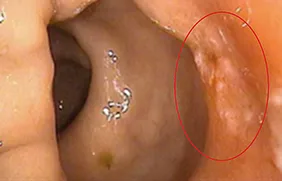 Figure 2A : Réponse endoscopique subcomplète