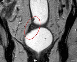 Figure 2B : Réponse radiologique subcomplète (ymrTGR2)