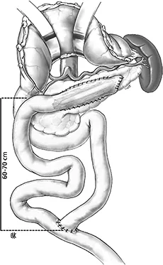 Figure 1 : Dérivation wirsungojéjunale sur anse en Y