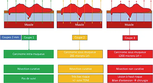 Figure 1 : résultat de l’analyse histologique d’un adénocarcinome invasif dans la sous- muqueuse sur 1 400 microns avec emboles, en fonction du positionnement des coupes