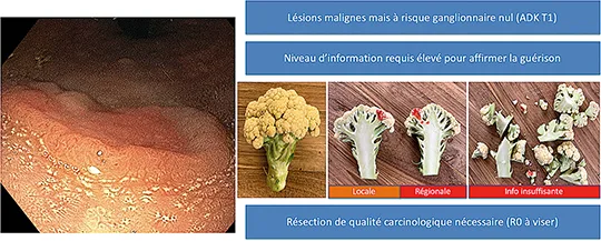 Figure 2 : représentation schématique de l’intérêt d’une résection en bloc avec marges afin de trouver l’information (profondeur d’invasion, infiltration lymphovasculaire, Budding) par rapport à une résection fragmentée