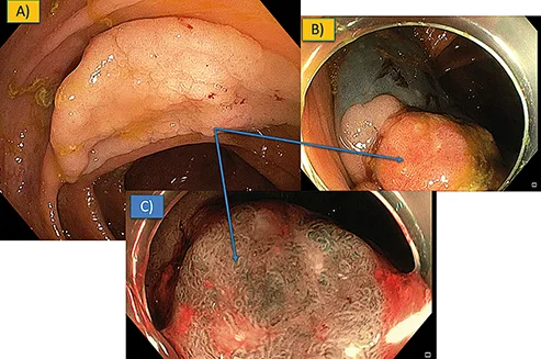 Figure 4 : photos clefs d’une analyse par endoscopie avancée de lésion colorectale