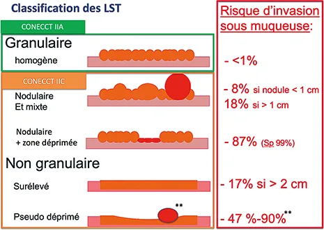 Figure 5 : Critères statistiques de risque de cancer T1 au sein des laterally spreading tumours