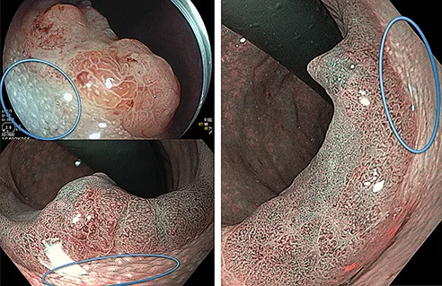 Figure 6 : Aspect en « peau de poulet » ou « chicken skin »