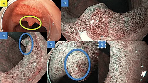 Figure 7 : Détection d’un nodule dans une dépression sur lequel on va porter particulièrement l’examen minutieux