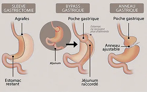 Figure 1 : présentation simplifiée des interventions de chirurgie bariatrique. Source : HAS
