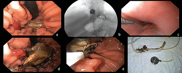 Figure 2 : Section et ablation endoscopique d’un anneau gastrique ajustable migré dans l’estomac