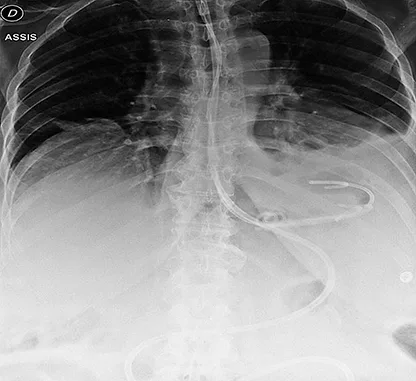 Figure 4 : Drainage interne par QDC après SG : 2 QDC et 1 drain nasocavitaire dans la fistule, sonde de nutrition entérale