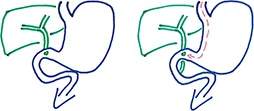 Figure 1 : Anastomose cholédoco- bulbaire latéro-latérale
