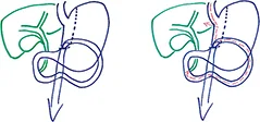 Figure 10 : Mini By-pass gastrique