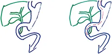 Figure 2 : Sleeve gastrectomie