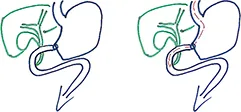 Figure 3 : Gastrectomie partielle selon Péan