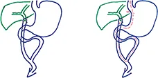 Figure 4 : Anastomose bilio-digestive sur anse jéjunale montée selon Roux