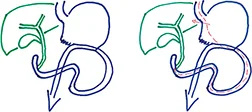 Figure 5 : Gastrectomie partielle selon Billroth II