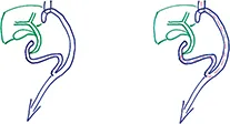 Figure 6 : Gastrectomie totale