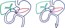 Figure 7 : Duodéno-pancréatectomie céphalique selon Whipple (DPC) 