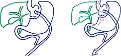 Figure 8 : By-pass gastrique en Y selon Roux (RYGB)