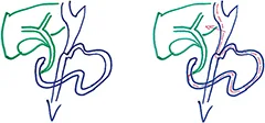 Figure 9 : Gastrectomie By-pass en Omega modifié