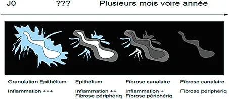 Figure 10 : Évolution du signal T2 en IRM d’une fistule