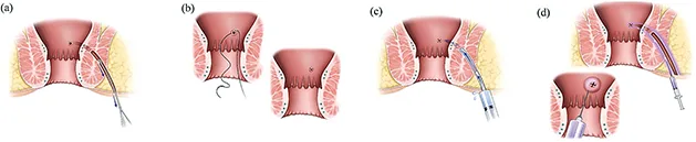 Le trajet fistuleux est cureté et rincé (a), l’orifice interne est fermé (b) et l’étanchéité vérifiée (c) les CSM sont injectés en sous muqueux sous l’orifice interne et dans les parois le long du trajet fistuleux (d)