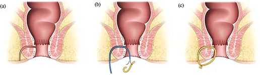 Figure 5 : Mise en place d’un séton de drainage, noué sans tension, dans une fistule anale