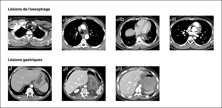 Figure 2 : Classification tomodensitométrique des lésions caustiques de l’œsophage et de l’estomac