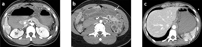 Figure 3 : Ingestion massive de caustique provoquant des lésions de nécrose du duodénum (a) de l’intestin grêle (b) et de la rate (c)